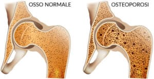 Magnetoterapia per osteoporosi