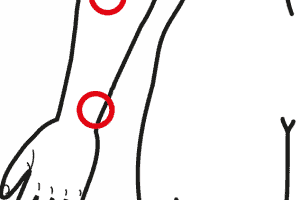 Tendinite Degli Estensori Della Mano
