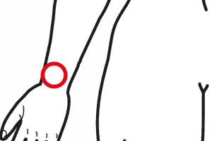 Morbo Di De Quervain O Stiloidite Radiale