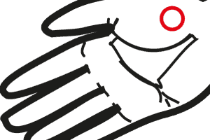 Artrosi Trapeziometacarpale – Rizoartrosi