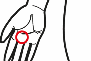 Morbo Di Dupuytren