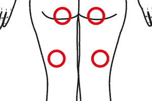Patologie Dei Muscoli Flessori