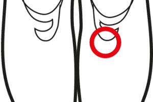Tendinite – Borsite Della Zampa D’Oca