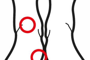 Tendinite Degli Estensori e Alluce Valgo