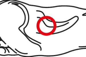 Metatarsalgia