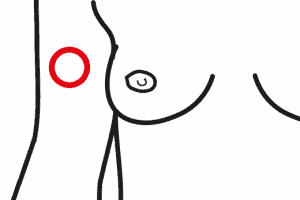 Cellulite Arti Superiori