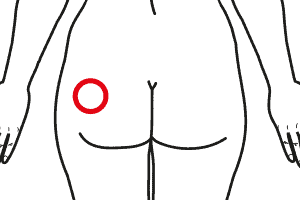 Cellulite Glutei