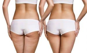 Eliminare la cellulite