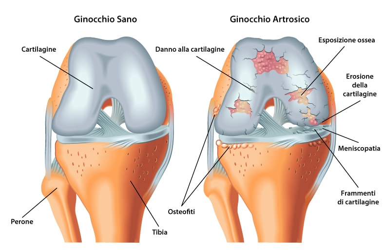 Artrosi Ginocchio Gonartrosi
