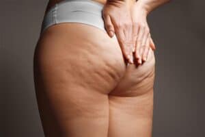 cellulite